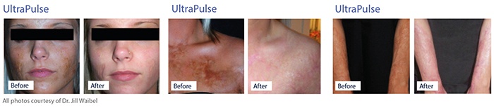 ultrapulse-laser-therapy-before-and-after.jpg