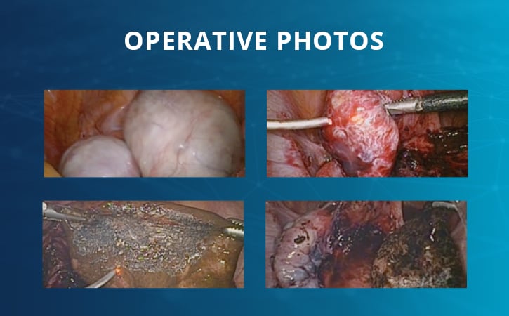 Laproscopy-Adhesiolysis-Excision-and-Ablation-of-Endometriomas-and-Deep-Infiltrating-Endometriosis-725x450