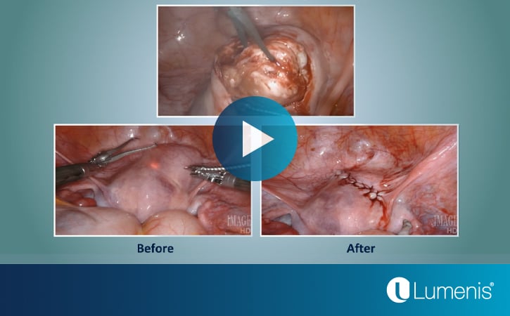 Lumenis-Gynecology-News-Page-Myomectomy-with-UPD-FiberLase-Robotic-Video-725x450