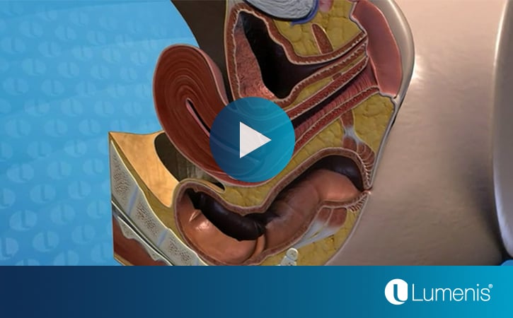 lumenis-gynecology-videos-page-colposcopy-video-display-image-725x450