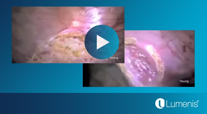 lumenis-gynecology-videos-page-excision-of-endometriosis-with-carbon-dioxide-lasere-video-display-image-725x400