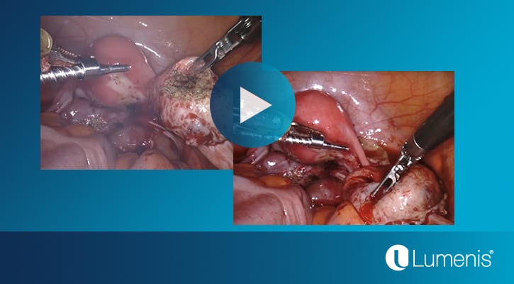 lumenis-gynecology-videos-page-robot-assisted-ablation-of-endometrioma-video-display-image-725x450